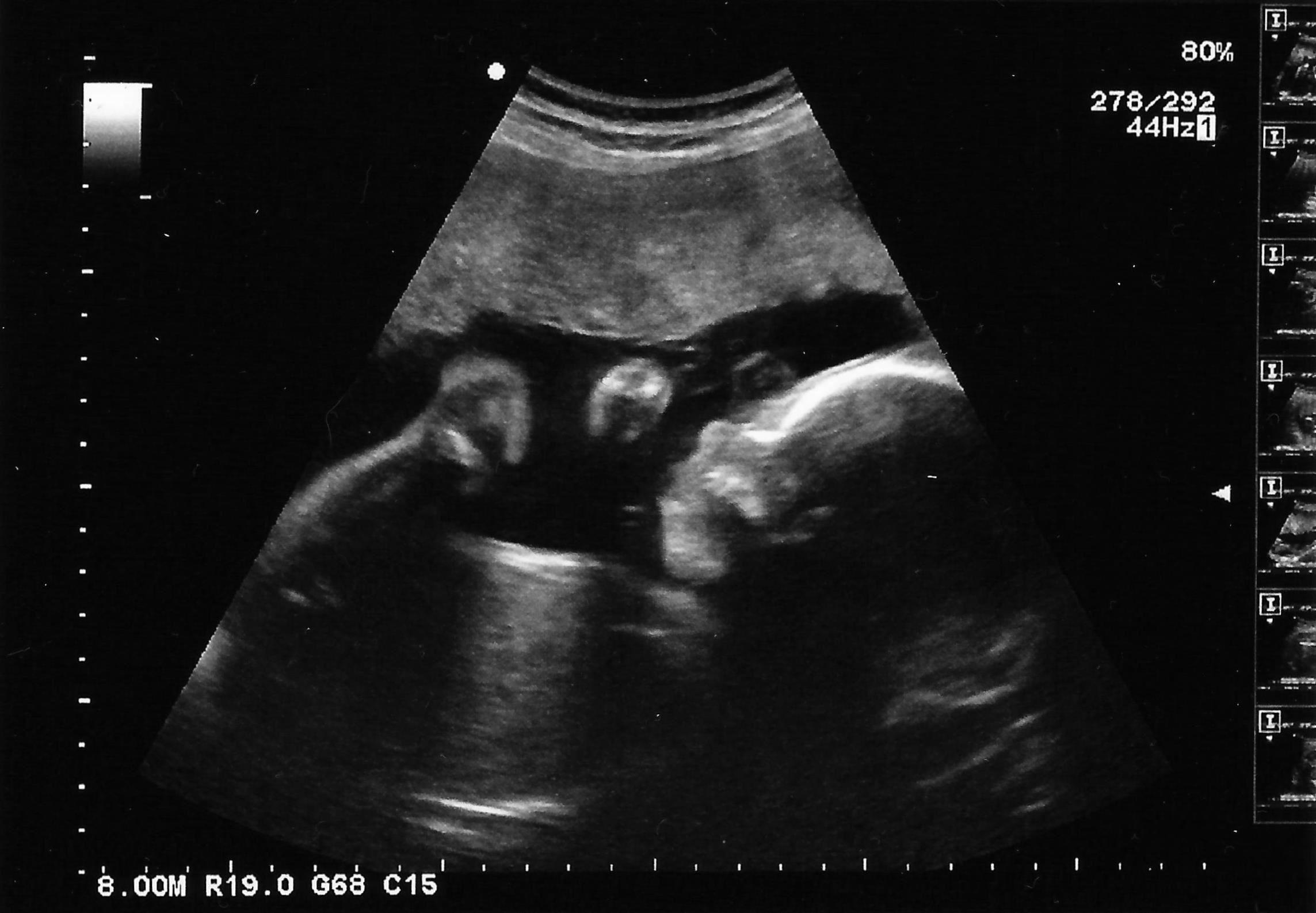 26 Week Growth Scan | Trying To Be A Good Mummy